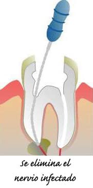 endodoncia se elimina el nervio infectado y se sellan los conductos radiculares en villafranca del castillo