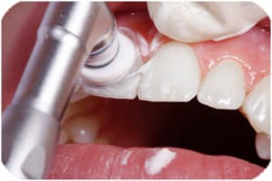 limpieza-dental-clinica-villafranca-del-castillo-madrid