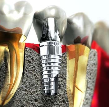 Implante dental en Villanueva de la Cañada
