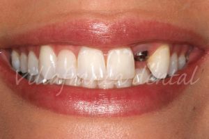 Implante dental en boca Implantologo-valdemorillo-quijorna-brunete-villafranca-castillo