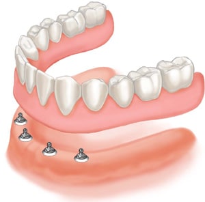 Prótesis dental en Villanueva de la Cañada (Madrid)